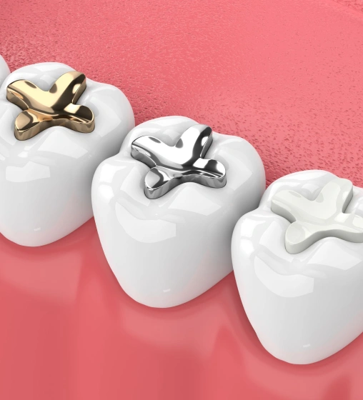 Tooth-Colored Fillings